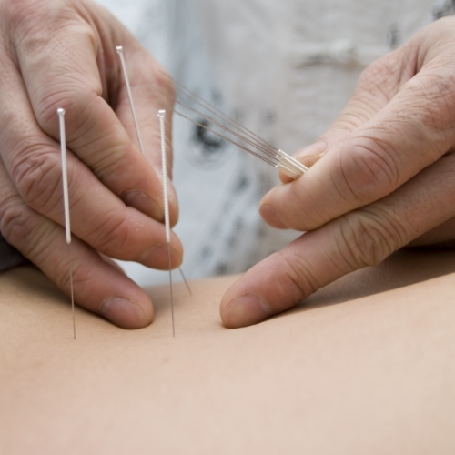 dry-needling-Achieve-Therapy-and-Fitness-Grand-Forks-ND-East-Grand-Forks-Park-Rapids-MN