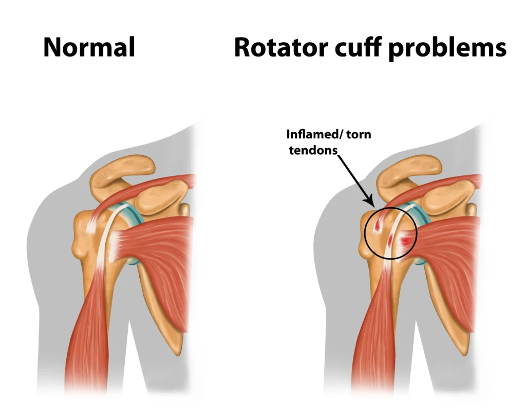 How Physical Therapy Can Help with Rotator Cuff Injuries