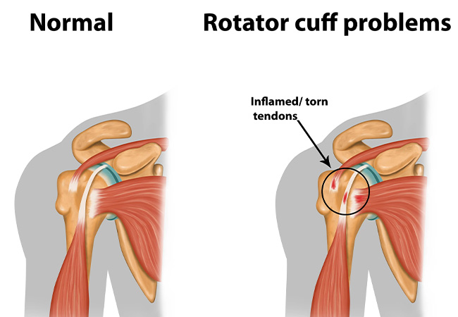 How Physical Therapy Can Help with Rotator Cuff Injuries