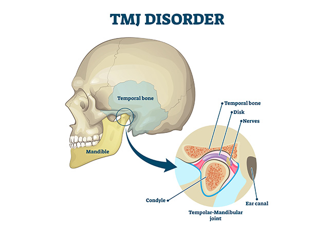 Are You Living With Jaw Pain? TMJ Could Be The Culprit